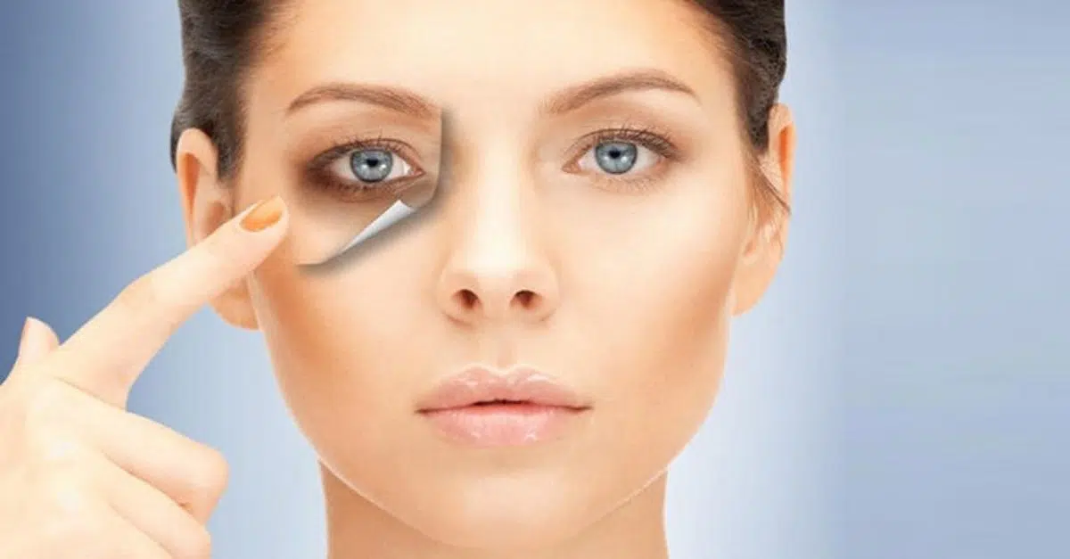What are the most effective treatments for dark eye circles in Singapore?