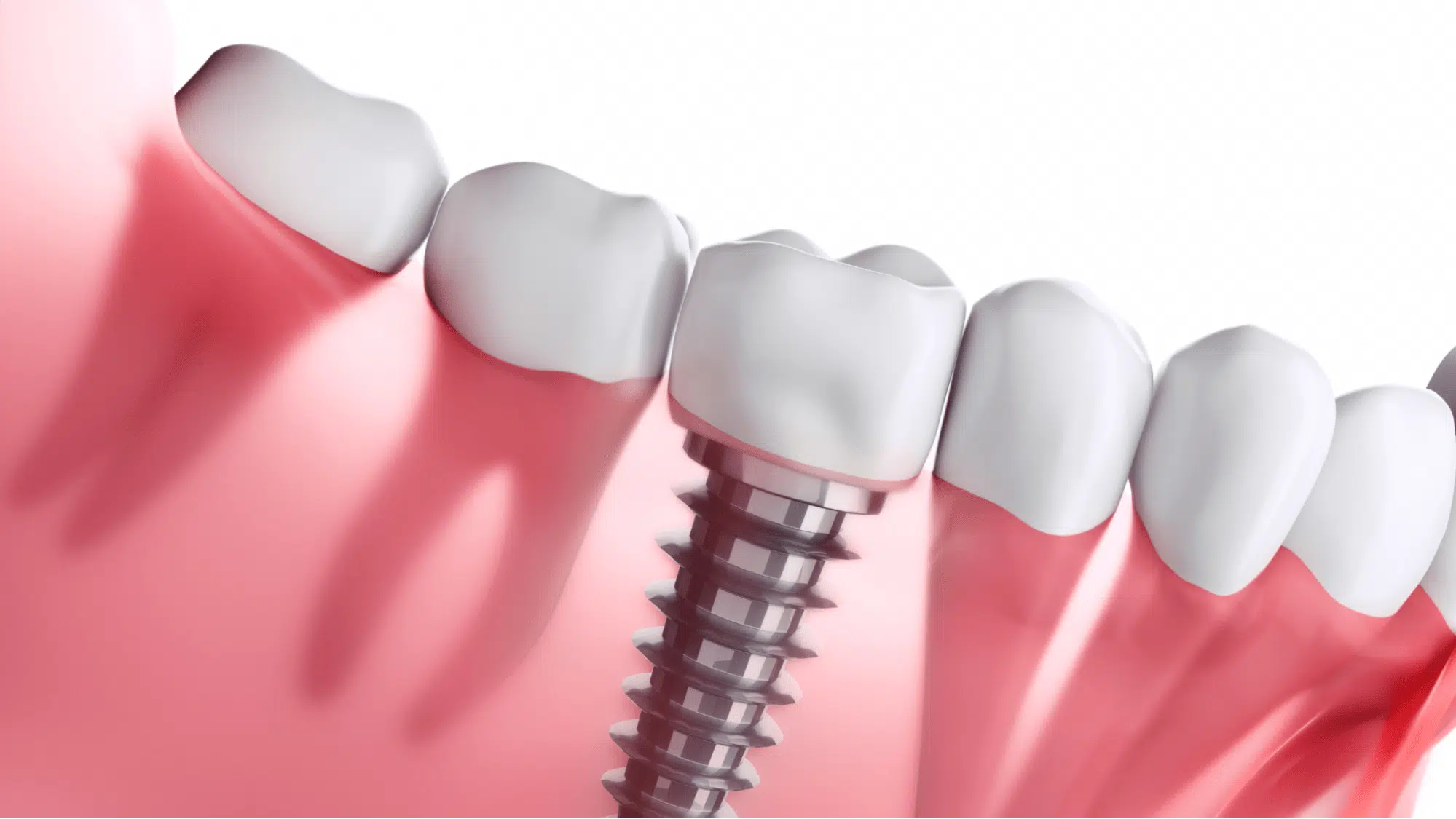 What Is Gingival Recession And How Can A Periodontist Help?