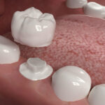 CEREC crowns