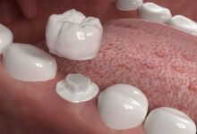 CEREC crowns