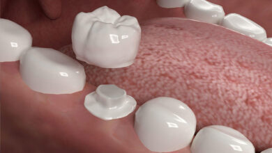 CEREC crowns