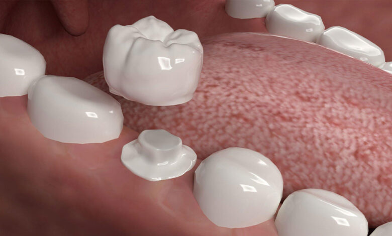 CEREC crowns