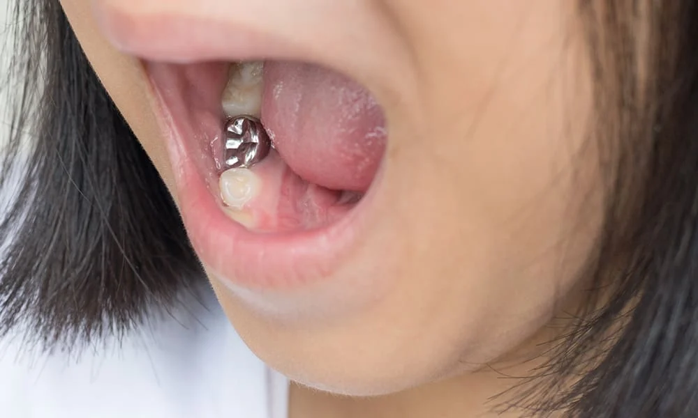 Understanding Temporary Dental Crowns: What You Need to Know