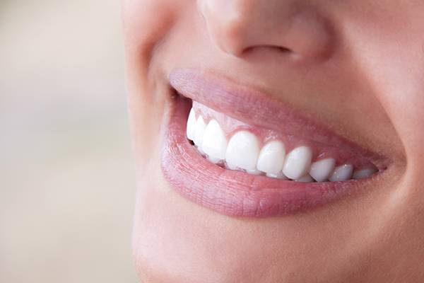 Professional teeth whitening