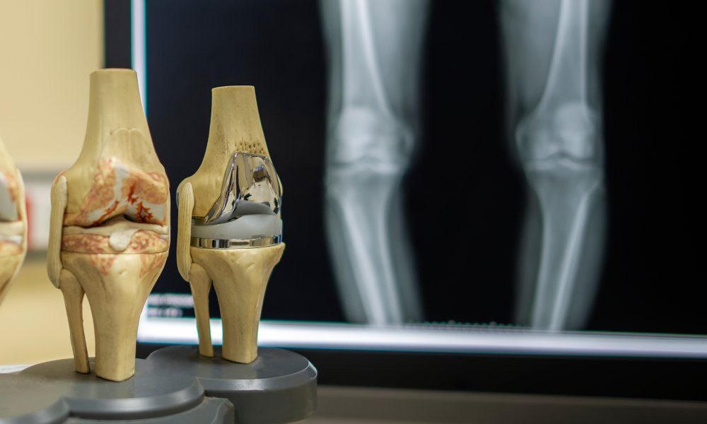 How Orthopedic Surgeons Are Revolutionizing Joint Replacement Surgery