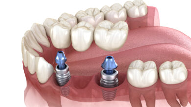 Dental Bridges