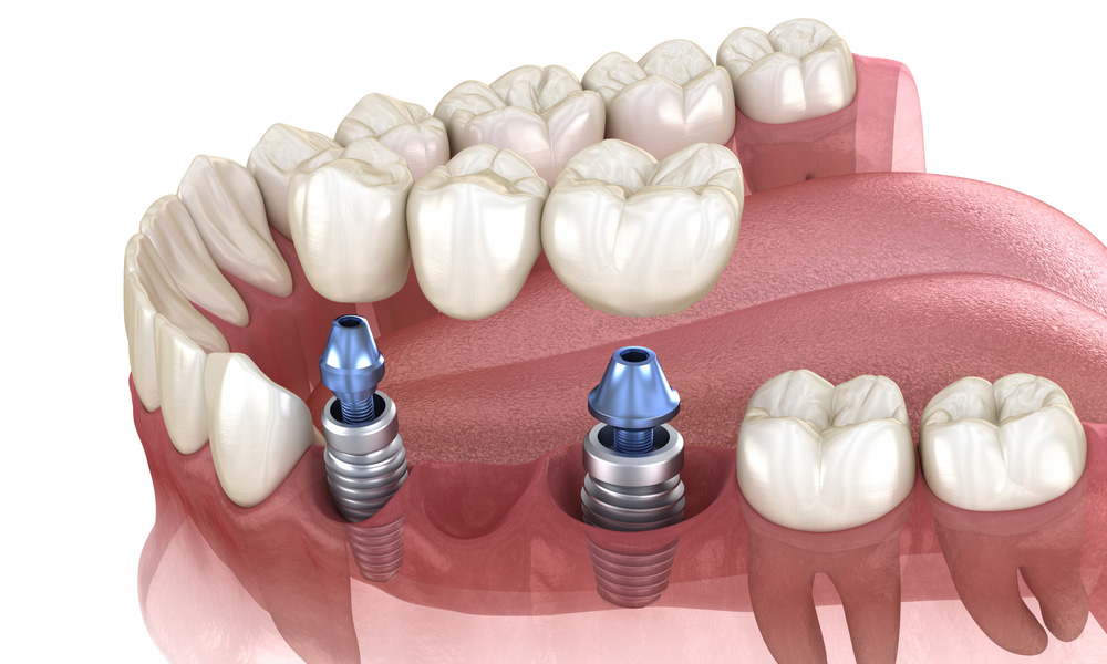 Dental Bridges in Boynton