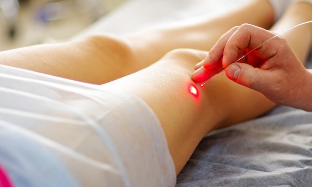 The Complete Guide to Varicose Vein Management