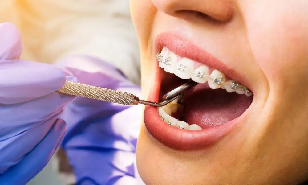 What Should You Do About Your Broken Bracket On Your Braces?