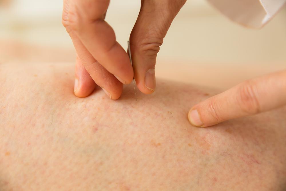 Acupuncture For Mental Health: A Closer Look