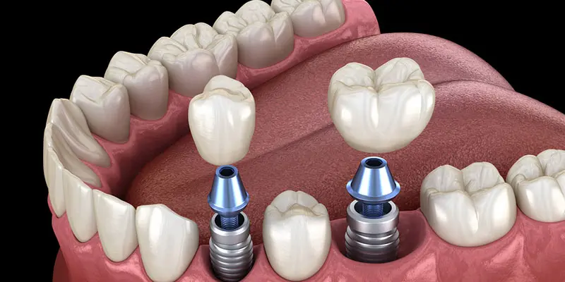Are Dental Implants Permanent? What to Expect Long-Term