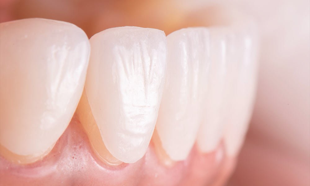 Protect Your Porcelain Veneers: 6 Simple Tips for a Long-Lasting Smile