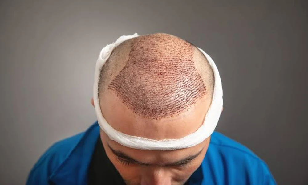 The Science of Hair Transplant: Examining the Effectiveness of the Procedure