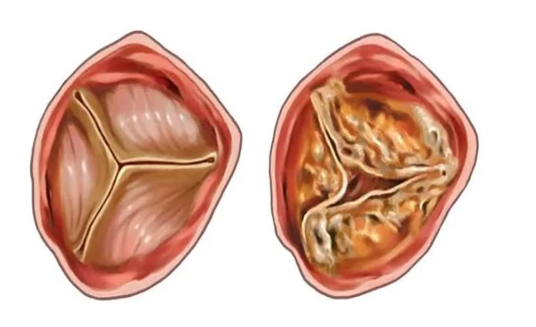 TMVR vs Mitral Valve Repair: Understanding Treatment Options for Mitral Valve Disease