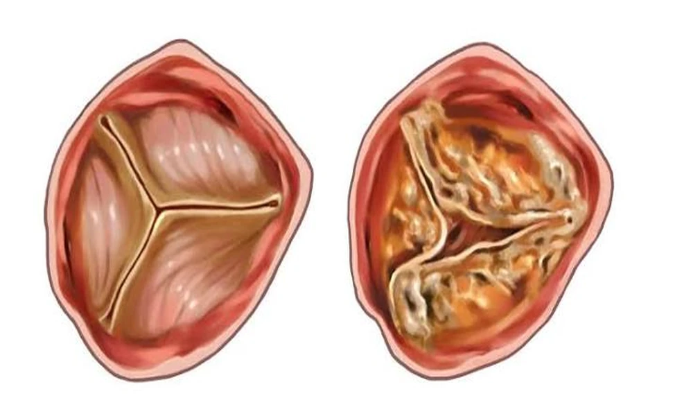 TMVR vs Mitral Valve Repair: Understanding Treatment Options for Mitral Valve Disease